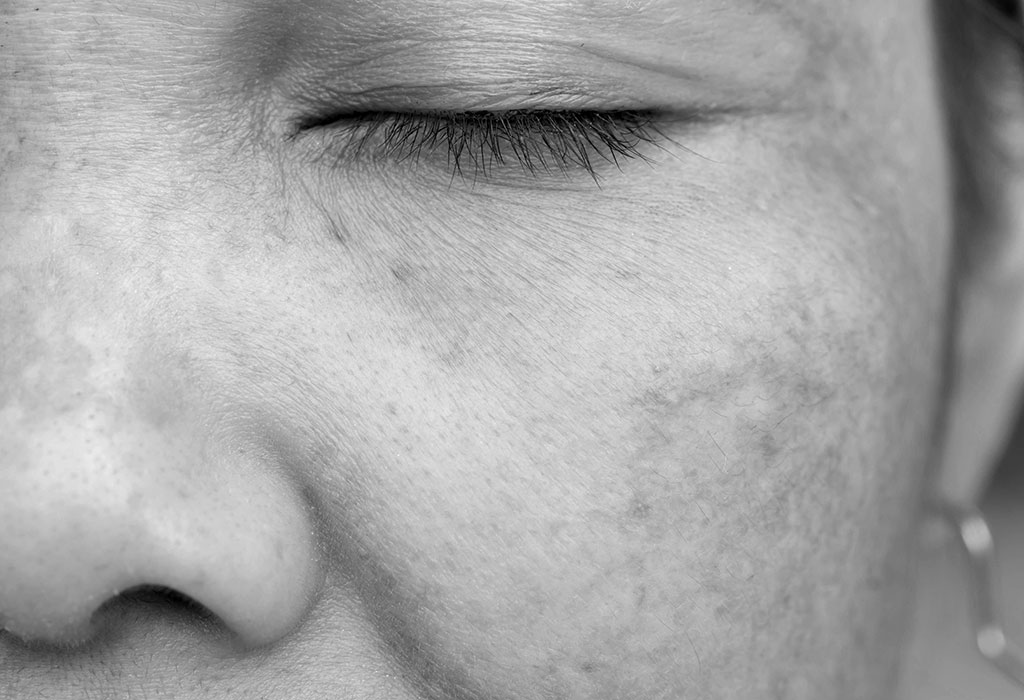 Peeling médico químico en Terrassa